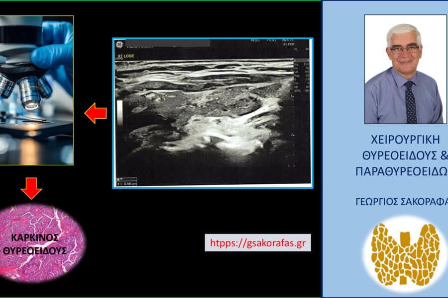 Καρκίνος θυρεοειδούς – μία ιδιαίτερη παρουσίαση (με αφορμή ασθενή μας)
