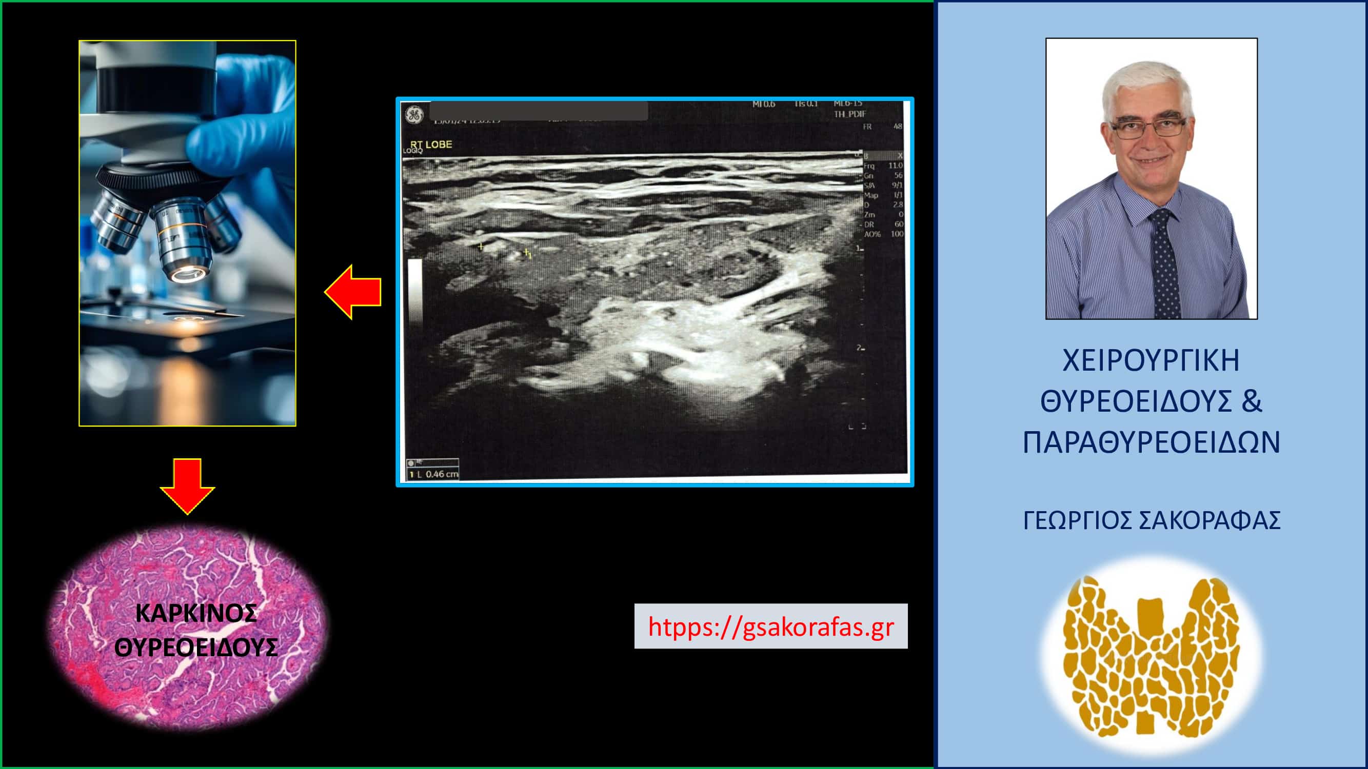 Καρκίνος θυρεοειδούς – μία ιδιαίτερη παρουσίαση (με αφορμή ασθενή μας)