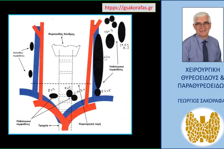 Καρκίνος θυρεοειδούς – γιατί η θυρεοειδεκτομή δεν είναι η κατάλληλη θεραπεία σε όλες τις περιπτώσεις και γιατί η θεραπεία θα πρέπει να εξατομικεύεται. Με αφορμή ασθενή μας