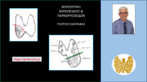 Πάνω αριστερά απεικονίζεται σχηματικά η αρχική επέμβαση. Ο όζος που βρίσκεται στον κάτω πόλο του δεξιού λοβού αφαιρέθηκε με μερική λοβεκτομή (εκτομή του όζου). Η διακεκομμένη κόκκινη γραμμή αντιστοιχεί στο επίπεδο διατομής του λοβού και το κόκκινο περίγραμμα ορίζει το μέρος του δεξιού λοβού που αφαιρέθηκε στην αρχική επέμβαση (1981). Κάτω δεξιά απεικονίζονται τα ευρήματα του υπερηχογραφικού ελέγχου πριν την νέα επέμβαση (συμπληρωματική ολική θυρεοειδεκτομή). Η πράσινη γραμμή σχηματικά αναπαριστά την κλείδα, δείχνοντας την κατάδυση του αριστερού λοβού στο μεσοθωράκιο (βλ. κείμενο). Σημειώνονται επίσης σχηματικά οι όζοι που εντοπίζονται σε αμφότερους τους λοβούς, και στον υπολειμματικό δεξιό και στον αριστερό (οι περισσότεροι και μεγαλύτεροι αριστερά).