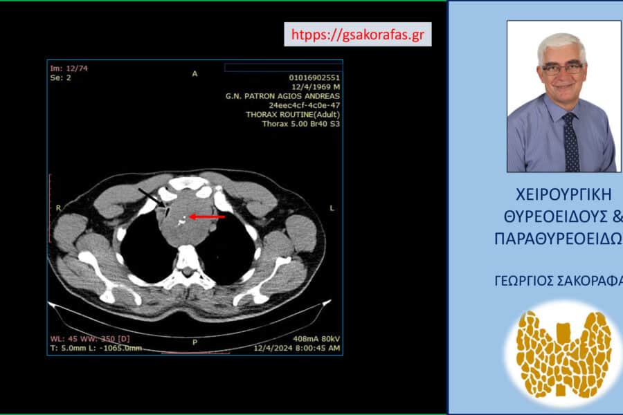 Καταδυόμενη βρογχοκήλη, με οξύ επεισόδιο δύσπνοιας λόγω σημαντικής (γραμμοειδούς) στένωσης της τραχείας και με βαθιά κατάδυση – επείγουσα ολική θυρεοειδεκτομή. Στην εικόνα αυτή της αξονικής τομογραφίας είναι εμφανής η πολύ μεγάλου βαθμού στένωση του αυλού της τραχείας (μαύρο βέλος) που απωθείται προς τα δεξιά από τον λίαν ευμεγέθη (γιγάντιο) καταδυόμενο αριστερό λοβό του θυρεοειδούς (κόκκινο βέλος).