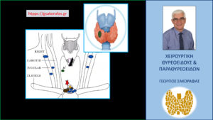 Καρκίνος θυρεοειδούς και μεταστάσεις στους λεμφαδένες – έχει σημασία το μέγεθος του καρκίνου;