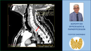 Αδένωμα παραθυρεοειδούς – διπλό, υπεράριθμο, έκτοπο, ενδοθωρακικό, οπισθοοισοφαγικό αδένωμα παραθυρεοειδούς σε υπερήλικα ασθενή μας με επιμένοντα υπερπαραθυρεοειδισμό.