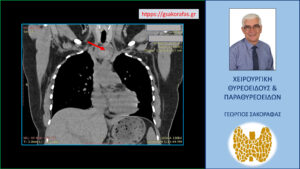 Ευμεγέθης καταδυόμενος εξωφυτικός όζος θυρεοειδούς (κόκκινο βέλος)– ευρήματα στην αξονική τομογραφία (βλ. κείμενο)