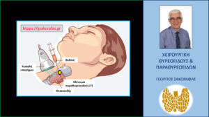 Αδένωμα παραθυρεοειδούς και παρακέντηση με λεπτή βελόνη (FNA)- έχει θέση και πότε?