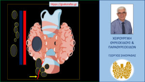 Καρκίνος θυρεοειδούς – κεντρικός λεμφαδενικός καθαρισμός και παλίνδρομο λαρυγγικό νεύρο (με αφορμή ασθενή μας)