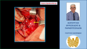 Το αδένωμα παραθυρεοειδούς (κίτρινο βέλος) στην εξέλιξη της επέμβασης αναγνωρίζεται και κινητοποιείται μετά ανάσπαση του αριστερού λοβού του θυρεοειδούς προς την μέση γραμμή (βέλος με διακεκομμένη μαύρη γραμμή)