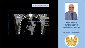 Διαφορετική τομή σε στεφανιαίο επίπεδο στην αξονική τομογραφία. Η βλάβη επισημαίνεται με κίτρινο βέλος (βλ. κείμενο). Εμφανής η ενδοθωρακική της κατάδυση
