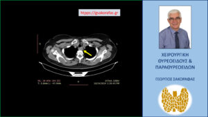 Αδένωμα παραθυρεοειδούς – Γιγάντιο οπισθοτραχειακό, οπισθοοισοφαγικό, προσπονδυλικό, καταδυόμενο ενδοθωρακικά, ορμονικά ανενεργό αδένωμα παραθυρεοειδούς – απεικόνιση σε εγκάρσια διατομή στην αξονική τομογραφία