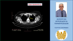Αξονική τομογραφία – απεικόνιση του αδενώματος σε εγκάρσια διατομή (κίτρινο βέλος) σε χαμηλότερο επίπεδο στο θώρακα