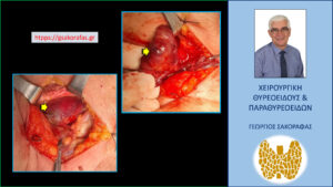 Το γιγάντιο, ορμονικά ανενεργό, καταδυόμενο, οπισθοτραχειακό, οπισθοοισοφαγικό αδένωμα παραθυρεοειδούς μετά τον εντοπισμό και την αρχική κινητοποίησή του στην διάρκεια της επέμβασης (κίτρινο βέλος)