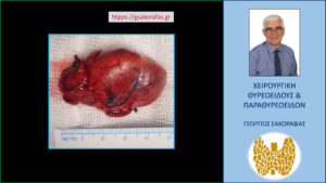 Το χειρουργικό παρασκεύασμα – γιγάντιο, έκτοπο, ορμονικά ανενεργό αδένωμα παραθυρεοειδούς