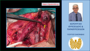 Διεγχειρητικά ευρήματα. 1=ο παθολογικός λεμφαδένας ψηλά στον τράχηλο (επίπεδο ΙΙβ), πάνω από το αριστερό παραπληρωματικό νεύρο (κίτρινο βέλος και άκρη της ανατομικής λαβίδας). 2=αριστερή έσω σφαγίτιδα φλέβα, 3=στερνοκλειδομαστοειδής μυς. Στη φάση αυτή της επέμβασης ο αριστερός πλάγιος λεμφαδενικός καθαρισμός έχει προχωρήσει αρκετά και απομένει η αφαίρεση του ευμεγέθους παθολογικού λεμφαδένα (1).