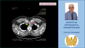 Αξονική τομογραφία (εγκάρσια διατομή) – εμφανής η μεγάλου βαθμού διόγκωση του αριστερού λοβού του θυρεοειδούς (κόκκινο βέλος) και η κατάδυσή του στο μεσοθωράκιο, όπως επίσης και η απώθηση της τραχείας προς τα δεξιά (κίτρινο βέλος).