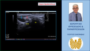 Το αδένωμα παραθυρεοειδούς - Απεικόνιση στο υπερηχογράφημα. TR = τραχεία, κίτρινο βέλος = αδένωμα παραθυρεοειδούς, κόκκινο βέλος = κοινή καρωτίδα, μπλε βέλος = έσω σφαγίτιδα φλέβα. Εμφανής η εν τω βάθει θέση του αδενώματος που εκτείνεται στην οπισθοπλάγια επιφάνεια της τραχείας, στην 7η με 8η ώρα αυτής, πίσω από την κοινή καρωτίδα αρτηρία και επί τα εντός αυτής και σε επαφή με την προσπονδυλική περιτονία.