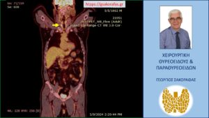 Καρκίνος θυρεοειδούς ως «τυχαίωμα» θυρεοειδούς – εύρημα σε PET-CT scan (με αφορμή ασθενή μας) (κίτρινο βέλος)