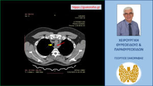 Αξονική τομογραφία (εγκάρσια διατομή, σε χαμηλότερο επίπεδο) – ο βαθιά καταδυόμενος αριστερός λοβός (κόκκινο βέλος) απωθεί την τραχεία (κίτρινο βέλος)