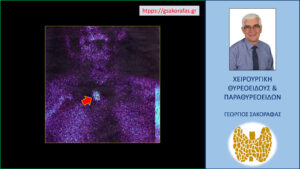 Απεικόνιση του αδενώματος στο σπινθηρογράφημα παραθυρεοειδών με Tc99m sestamibi (βέλος)