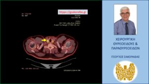 Εικόνα στο PET-CT scan σε εγκάρσια διατομή