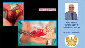 Εικόνα από την εξέλιξη της επέμβασης. Πάνω αριστερά, το αδένωμα παραθυρεοειδούς στην αρχική φάση της κινητοποιήσής του (βέλος). Κάτω δεξιά, το αδένωμα παραθυρεοειδούς στην τελική φάση της επέμβασης, μετά την πλήρη κινητοποίησή του και λίγο πριν την αφαίρεσή του.