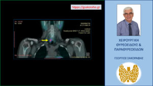 Απεικόνιση του αδενώματος στο SPECT-CT (σε διαφορετική τομή)