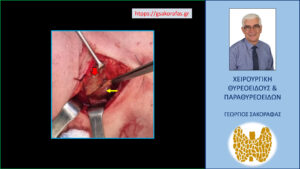 Ευρήματα στην διάρκεια της επέμβασης. Ο λοβός του θυρεοειδούς σε θέση ανάσπασης (κόκκινο βέλος). Το αδένωμα επισημαίνεται με κίτρινο βέλος.