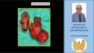 Χειρουργικό παρασκεύασμα. Ο θυρεοειδής αδένας του ασθενούς μετά την ολοκλήρωση της επέμβασης. Με κίτρινη διακεκομμένη γραμμή απεικονίζονται οι φυσιολογικές διαστάσεις του θυρεοειδούς.