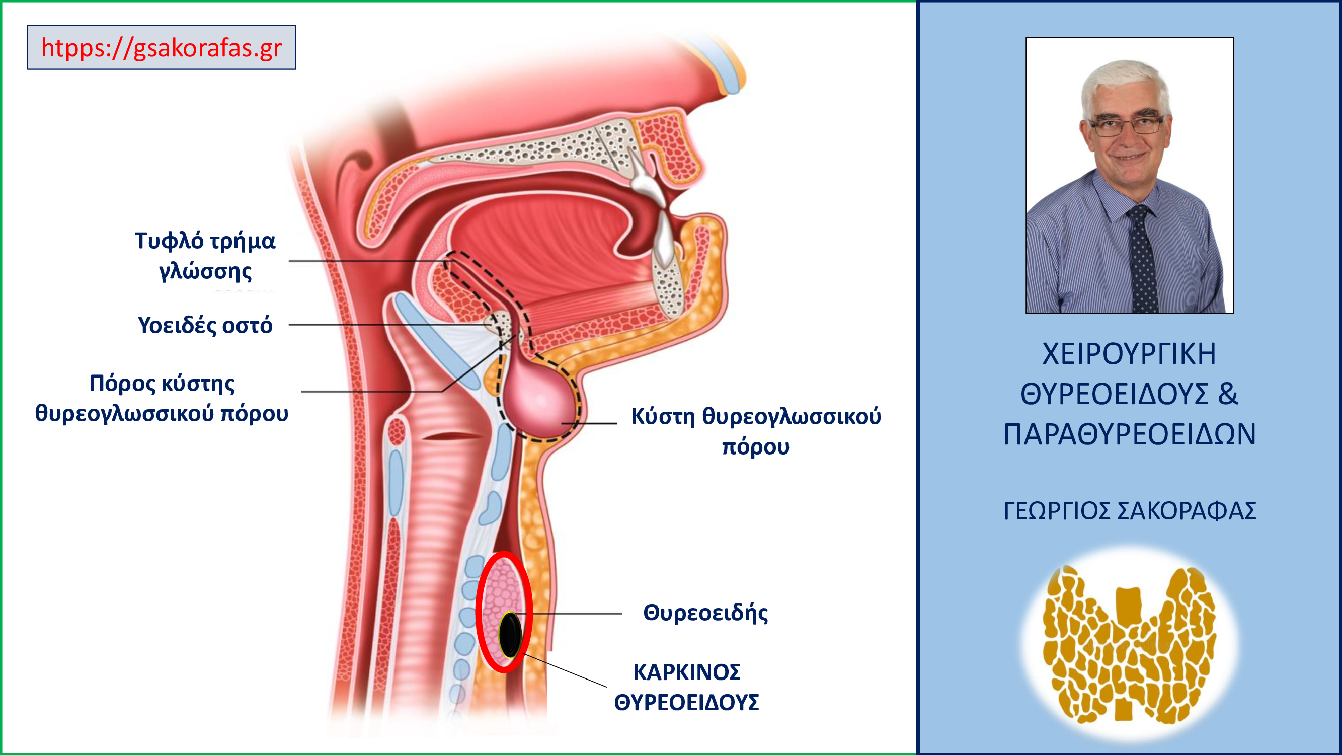 Κύστη θυρεογλωσσικού πόρου – συνδυασμένη αφαίρεσή της με ριζική επέμβαση παράλληλα με ολική θυρεοειδεκτομή για καρκίνο θυρεοειδούς (με αφορμή ηλικιωμένη ασθενή μας)