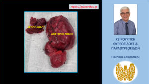 Χειρουργικό παρασκεύασμα μετά την θυρεοειδεκτομή. Εμφανής η μεγάλη διαφορά μεγέθους μεταξύ των δύο λοβών. Ο λίαν ευμεγέθης αριστερός λοβός καταδύεται σε βάθος στο θώρακα (βλ. κείμενο).