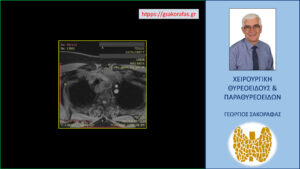 Εικόνα από την μαγνητική τομογραφία – εγκάρσια διατομή σε χαμηλότερο επίπεδο. Εμφανής η κατάδυση του ευμεγέθους όζου στο θώρακα.