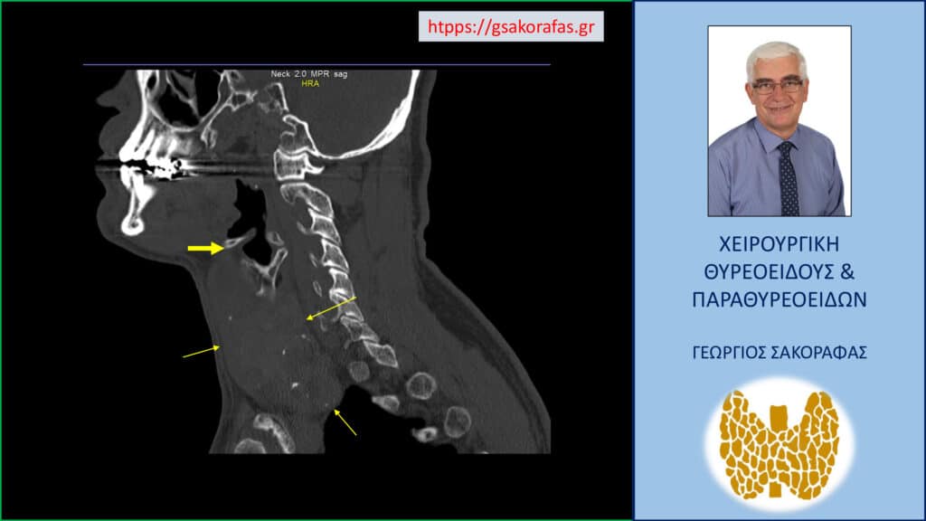 Γιγάντια τοξική βρογχοκήλη, με οριακή κατάδυση– εικόνες (σε ασθενή μας). Απεικόνιση στην αξονική τομογραφία. Εμφανής η πολύ μεγάλου βαθμού διόγκωση του θυρεοειδούς που καταλαμβάνει πρακτικά όλον τον τράχηλο, από το ύψος του υοειδούς οστού (παχύ κίτρινο βέλος) και καταδύεται οριακά στο μεσοθωράκιο (κάτω κίτρινο βέλος).