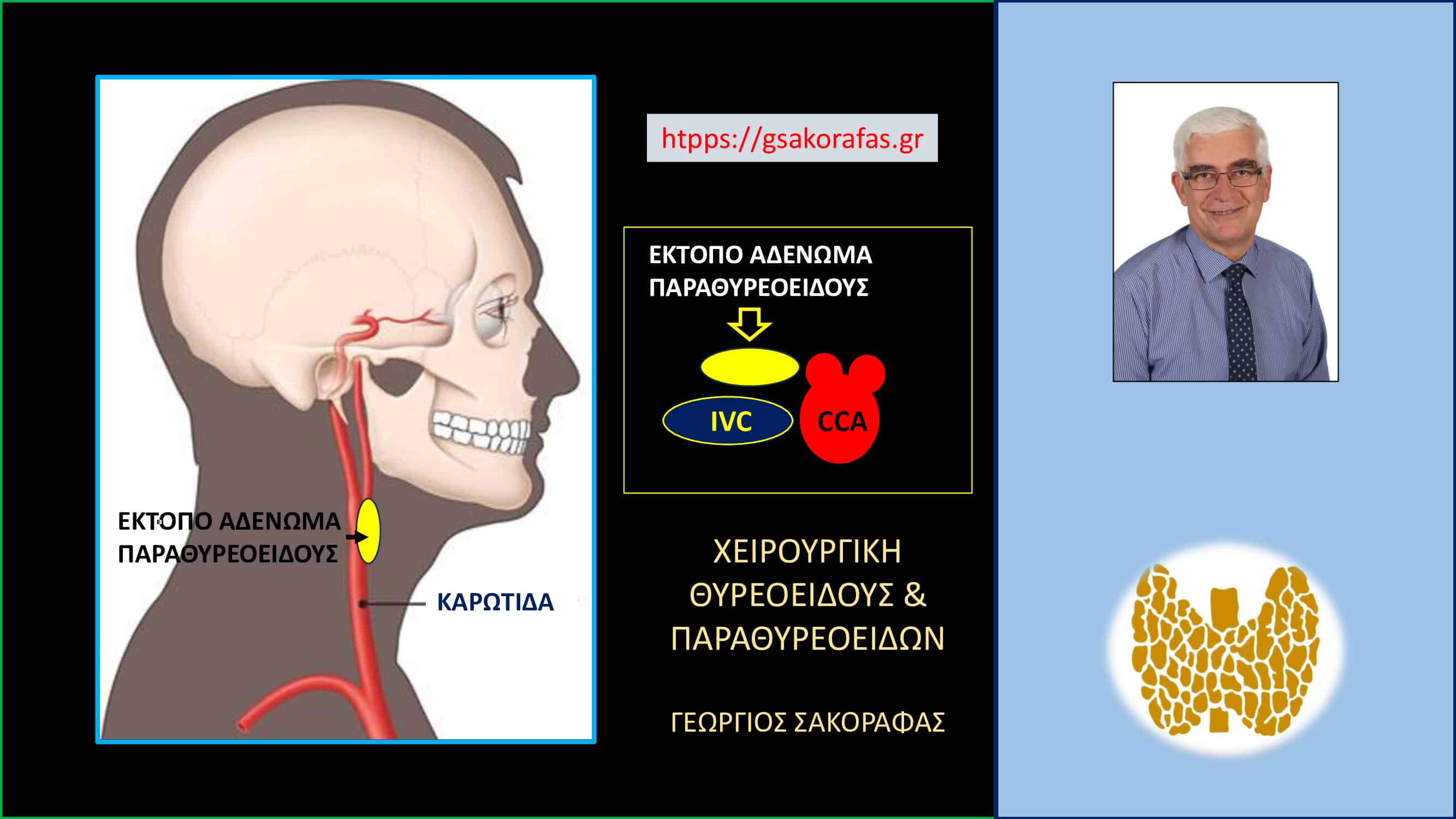 Αδένωμα παραθυρεοειδούς σε έκτοπη θέση – με αφορμή ασθενή μας (Εικόνες)