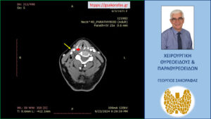 Απεικόνιση στην 4D – CT. To έκτοπο αδένωμα (κίτρινο βέλος) και οι ανατομικές του σχέσεις με την έσω σφαγίτιδα (μαύρο βέλος) και την καρωτίδα στο ύψος του διχασμού της (κόκκινο βέλος).