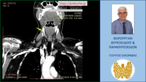 4D -CT. Απεικόνιση του έκτοπου αδενώματος παραθυρεοειδούς (κίτρινο βέλος) σε άλλη διατομή.