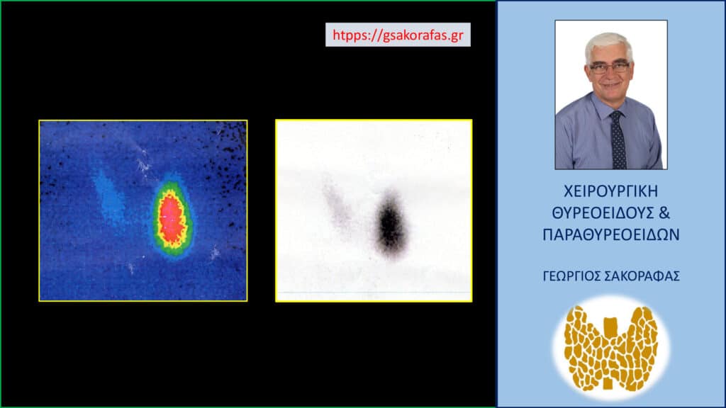 Τοξικό αδένωμα θυρεοειδούς – απεικόνιση στο σπινθηρογράφημα με εμφανή την καταστολή του λοιπού θυρεοειδικού παρεγχύματος