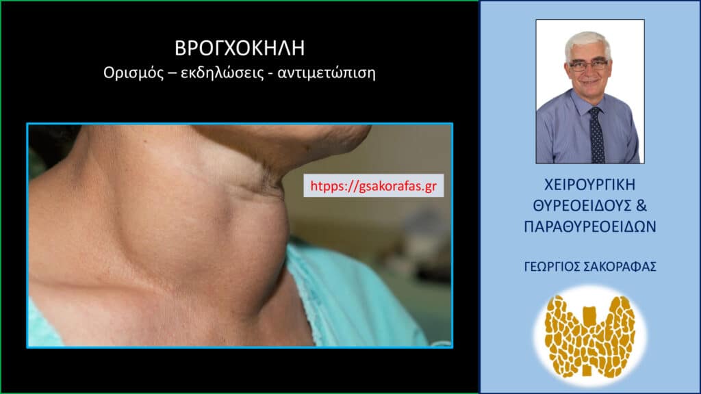 Βρογχοκήλη – Τι είναι? Τι προβλήματα μπορεί να δημιουργήσει? Πώς αντιμετωπίζεται?