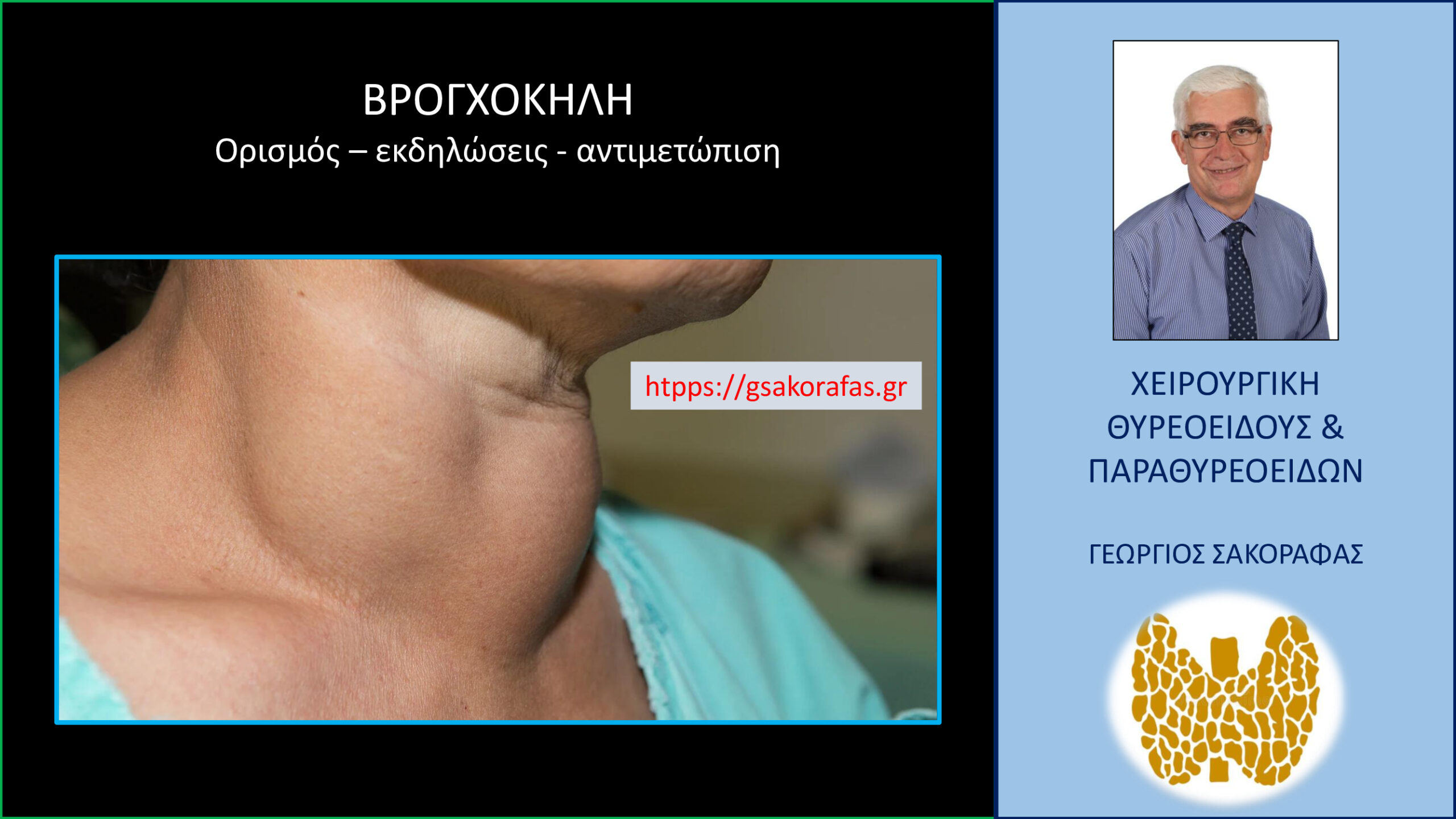 Βρογχοκήλη – Τι είναι? Τι προβλήματα μπορεί να δημιουργήσει? Πώς αντιμετωπίζεται?