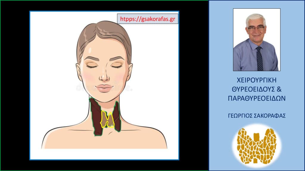 Γιγάντια τοξική βρογχοκήλη - Σχηματική αναπαράσταση του βαθμού διόγκωσης του θυρεοειδούς στην ασθενή μας. Ο θυρεοειδής με το κίτρινο περίγραμμα αντιστοιχεί στο μέγεθος ενός φυσιολογικού αδένα – για λόγους σύγκρισης με τον θυρεοειδή της ασθενούς που εικονίζεται σχηματικά με το πράσινο περίγραμμα