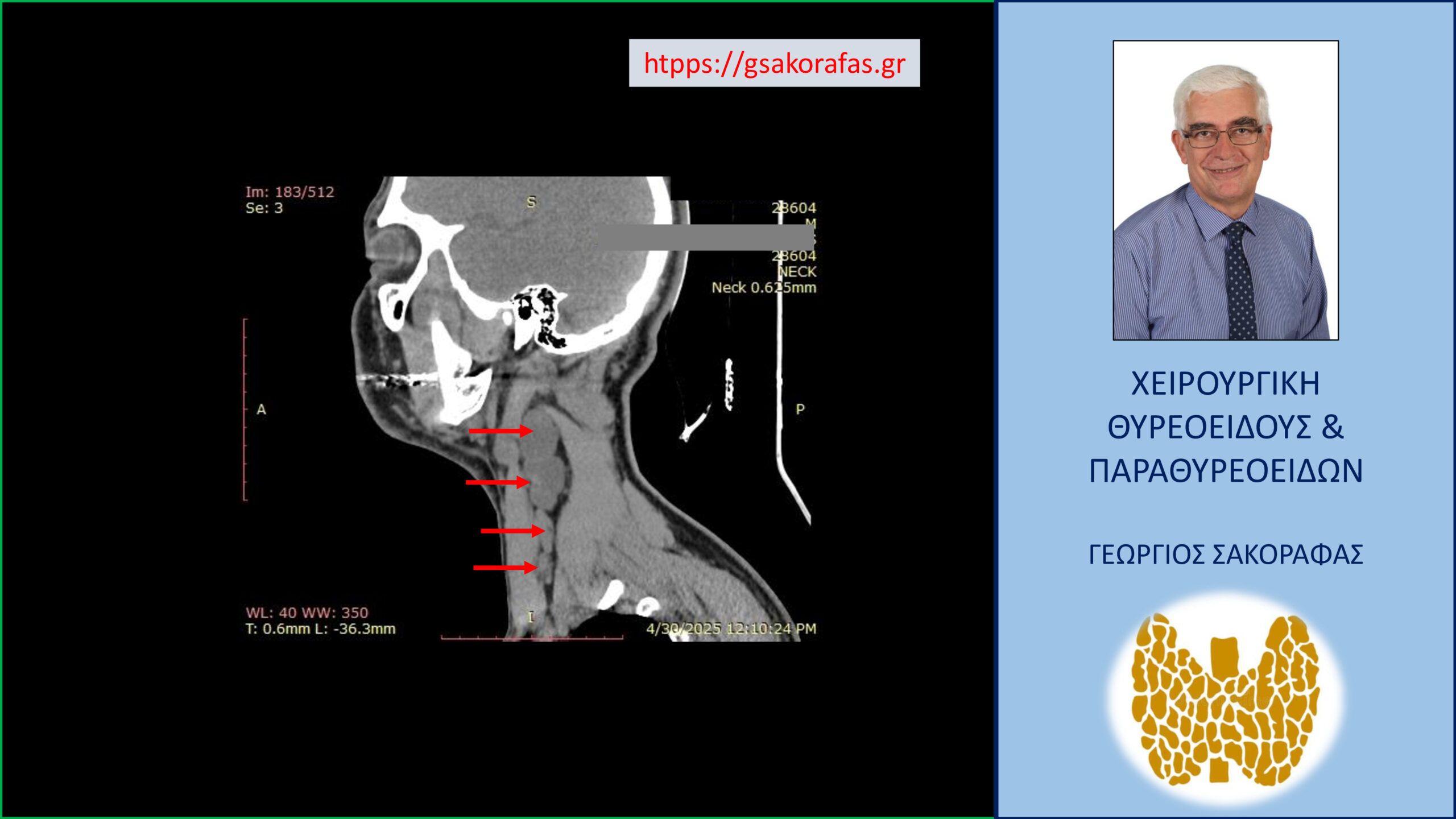 Καρκίνος θυρεοειδούς – κρύφιος (λανθάνων, occult thyroid cancer) με εκτεταμένες λεμφαδενικές μεταστάσεις σε νεαρό ασθενή
