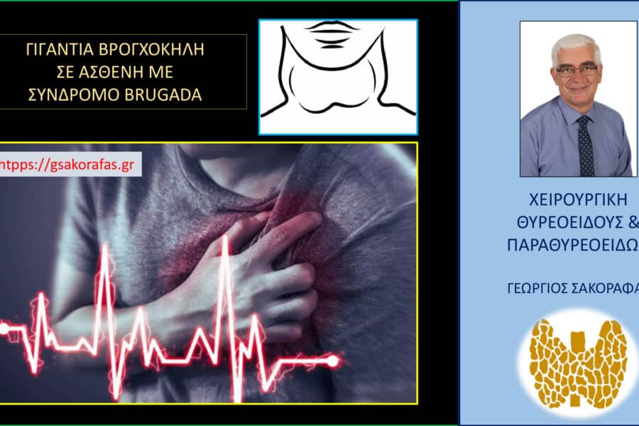 Βρογχοκήλη (γιγάντια, καταδυόμενη) – θυρεοειδεκτομή σε ασθενή με σύνδρομο Brugada
