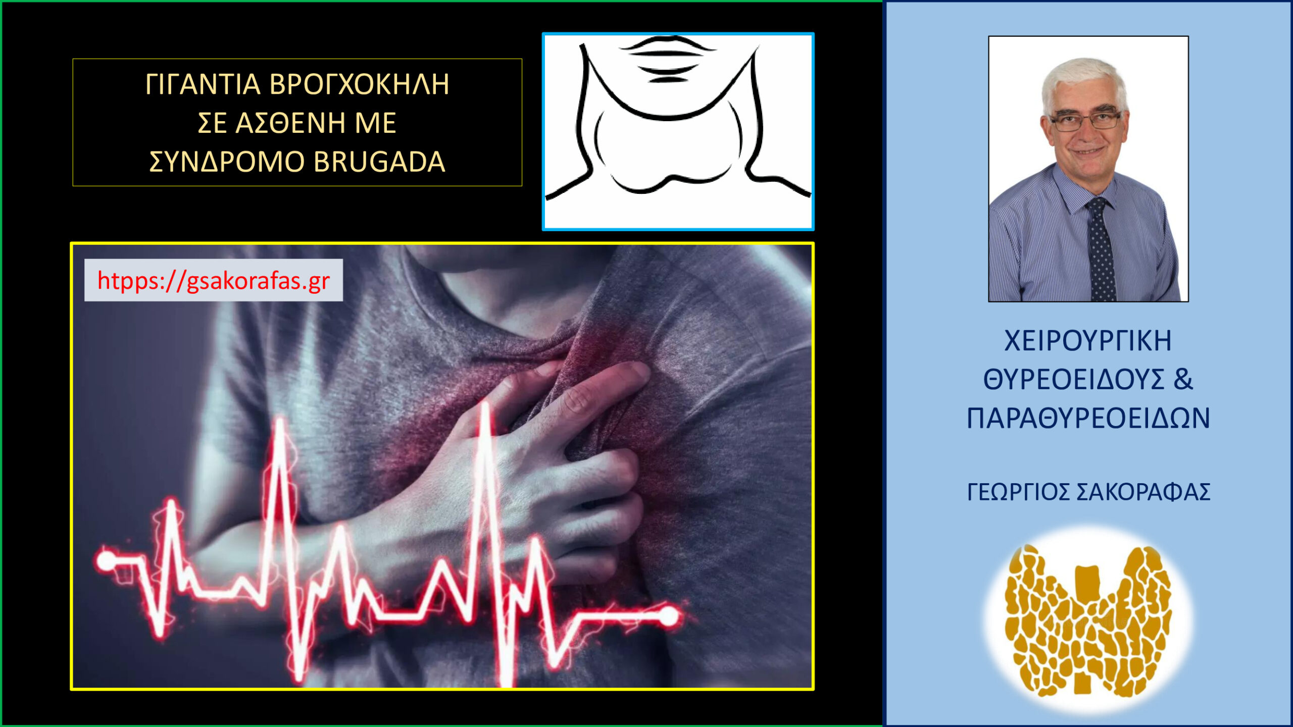 Βρογχοκήλη (γιγάντια, καταδυόμενη) – θυρεοειδεκτομή σε ασθενή με σύνδρομο Brugada