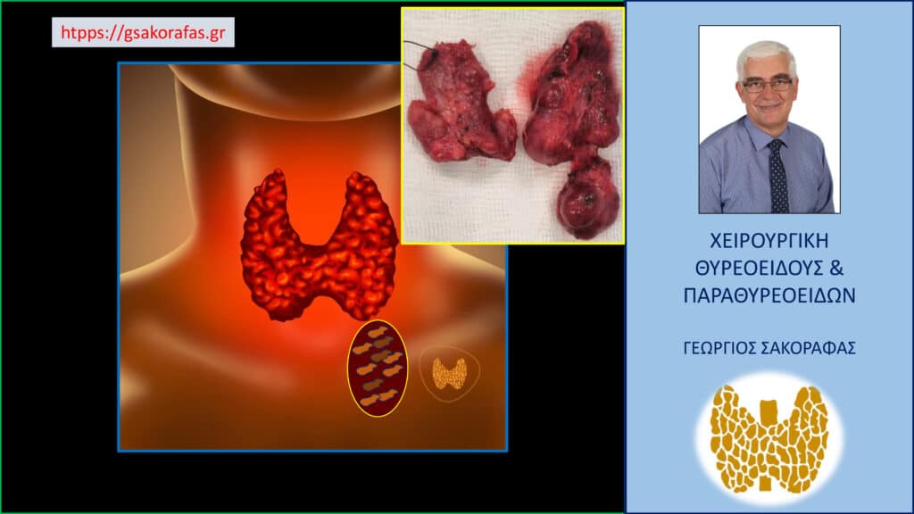 Όζος θυρεοειδούς με εξωφυτική ανάπτυξη και κατάδυση στο μεσοθωράκιο (καταδυόμενος εξωφυτικός όζος θυρεοειδούς – μία δυνητική παγίδα (με αφορμή ασθενή μας) (εικόνα)