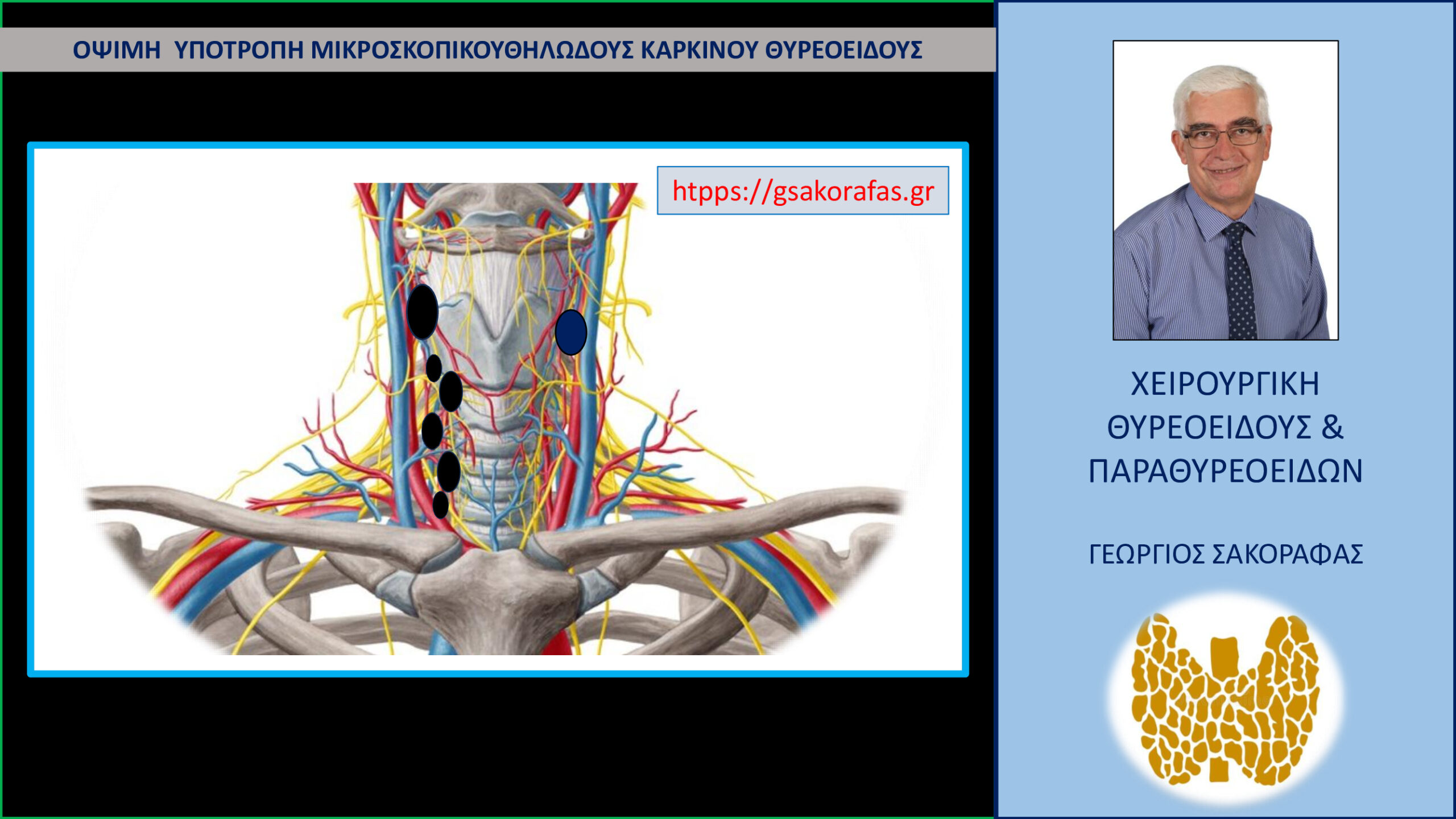 Καρκίνος θυρεοειδούς – εξαιρετικά όψιμη υποτροπή (σε δύσκολη θέση) μικροσκοπικού θηλώδους καρκίνου θυρεοειδούς (με αφορμή ασθενή μας