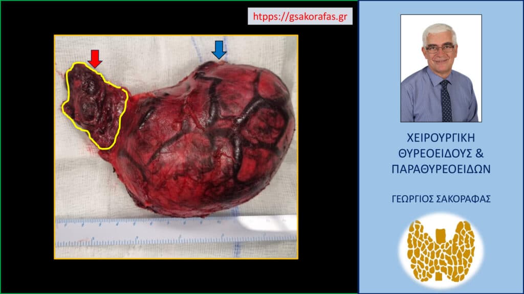 Χειρουργικό παρασκεύασμα (ο θυρεοειδής αδένας του ασθενούς μετά την αφαίρεσή του) - με το κίτρινο περίγραμμα απεικονίζεται ο δεξιός λοβός του θυρεοειδούς που έχει φυσιολογικό μέγεθος. Ο αριστερός λοβός παρουσιάζει σημαντικού βαθμού αύξηση των διαστάσεών του. Εμφανής η παρουσία λίαν ευμεγέθων αγγειακών κλάδων που αιματώνουν τον αριστερό λοβό - τα ευμεγέθη αυτά αγγεία δημιούργησαν επίσης πρόβλημα στην εξέλιξη της επέμβασης (πλούσια αιμάτωση).