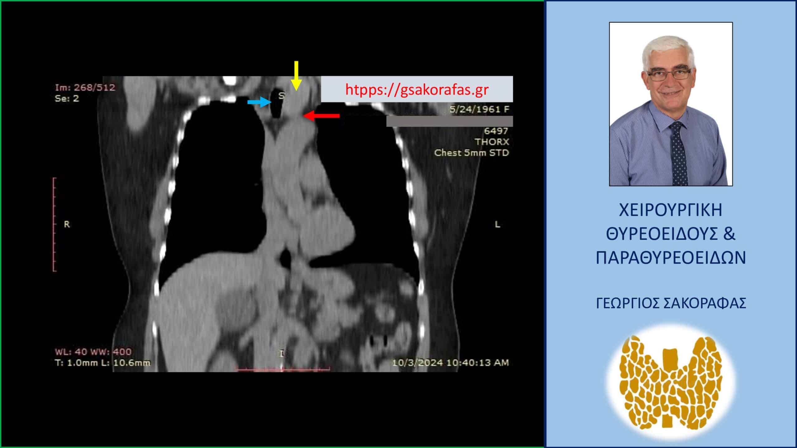 Όζος θυρεοειδούς καταδυόμενος αριστερά σε ασθενή μας με ιστορικό λοβεκτομής και θερμοκαυτηρίασης του όζου (Εικόνες)