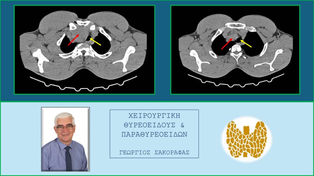 Όζος θυρεοειδούς – ευμεγέθης, καταδυόμενος στο θώρακα. Εγκάρσιες τομές στην αξονική τομογραφία στο ύψος του θώρακα. Εμφανής η κατάδυση του ευμεγέθους όζου (κόκκινο βέλος) στο μεσοθωράκιο, που απωθεί προς τα αριστερά την τραχεία (κίτρινο βέλος)