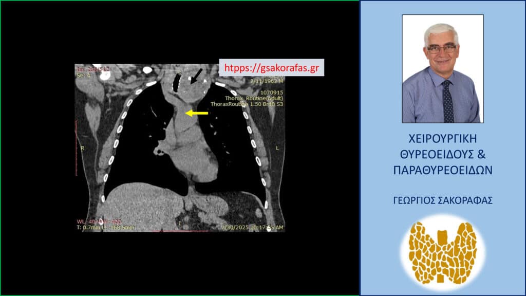 Καταδυόμενη βρογχοκήλη – βαθιά κατάδυση μέχρι το ύψος του αορτικού τόξου: αφαίρεση μέσω τραχηλικής τομής (εικόνες – με αφορμή ασθενή μας) Καταδυόμενη βρογχοκήλη –Αξονική τομογραφία θώρακα σε κατά μέτωπο διατομή. Ο διογκωμένος αριστερός λοβός του θυρεοειδούς (μαύρο βέλος) καταδύεται σε βάθος στο θώρακα φθάνοντας στο ύψος του άνω ορίου του αορτικού τόξου (κίτρινο βέλος).