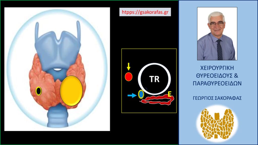 Αδένωμα παραθυρεοειδούς – σχετίζεται το μέγεθός του με την βαρύτητα του υπερπαραθυρεοειδισμού? (με αφορμή ασθενή μας) Αδένωμα παραθυρεοειδούς – σχηματική απεικόνιση των ευρημάτων στην ασθενή μας. Αριστερά απεικονίζεται ο ευμεγέθης αδενωματώδης όζος στον αριστερό λοβό του θυρεοειδούς με το αδένωμα παραθυρεοειδούς πίσω από την μεσότητα του δεξιού λοβού. Στο ένθετο της εικόνας (δεξιά) σε εγκάρσια διατομή η θέση του αδενώματος (μπλε βέλος), βαθιά στην δεξιά τραχειοοισοφαγική αύλακα, πίσω και επί τα εντός της δεξιάς κοινής καρωτίδας (κίτρινο βέλος), στην 7η ώρα της τραχείας (TR) και σε επαφή με την δεξιά επιφάνεια του οισοφάγου (E).