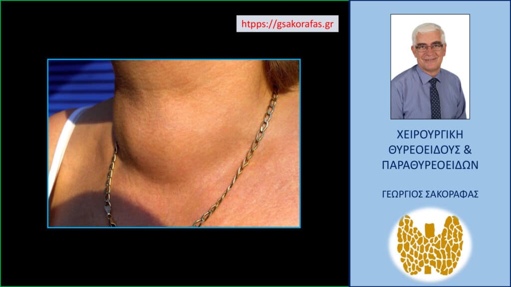 Βρογχοκήλη – Τι είναι? Τι προβλήματα μπορεί να δημιουργήσει? Πώς αντιμετωπίζεται? Βρογχοκήλη – Τι είναι? Τι προβλήματα μπορεί να δημιουργήσει? Πώς αντιμετωπίζεται?