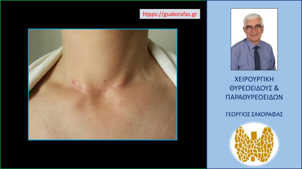 Θυρεοειδεκτομή και χηλοειδές: Πρόληψη και φροντίδα της ουλής στον τράχηλο